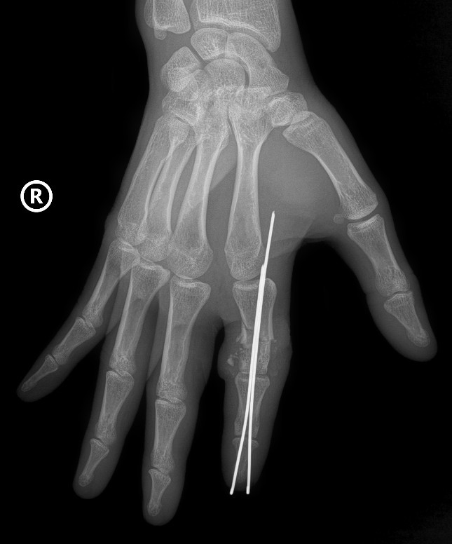 Röntgenbild av Mr. D:s avhuggna högra pekfinger som lokaliseras och fixeras med en specialnål. 2025-11-07-152758.png