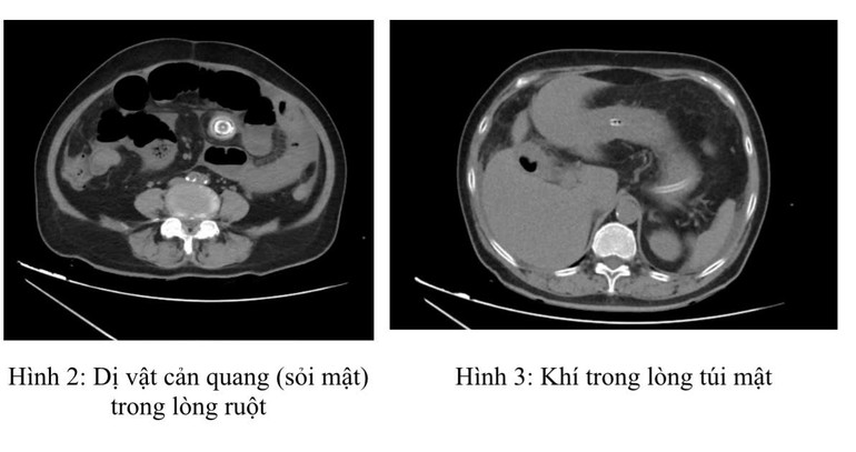 Hình ảnh phim chụp thấy rõ dị vật trong ruột và túi mật. 639e90d9-467f-4496-9207-e72daa04b2bf-mceu-78055631011749181239084.jpg