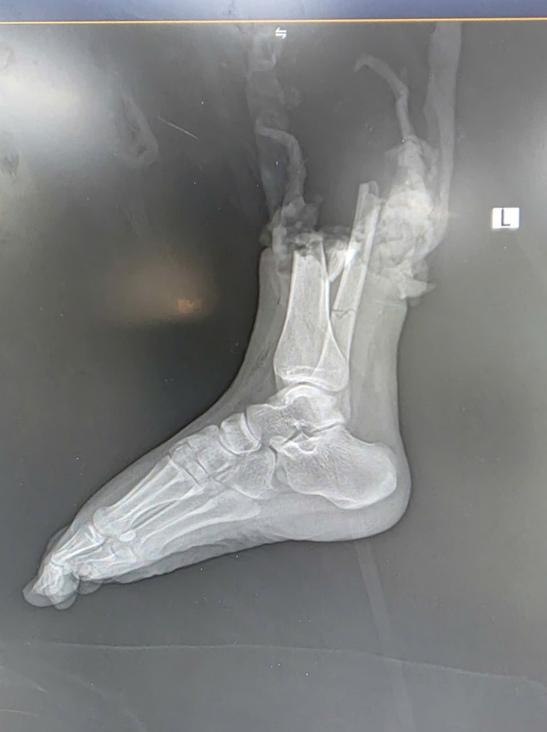 រូបភាព CT នៃដំបៅ។ 3125406007468273582-1-082506-291025-56.jpg