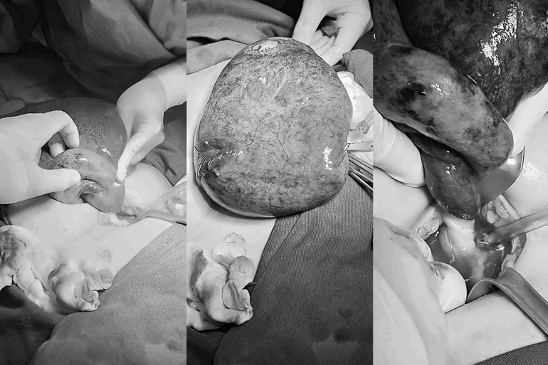 The giant tumor has the size of a 7-month fetus. z6858420285270-fd24a9516911a1917c64d831d01c0cff.jpg