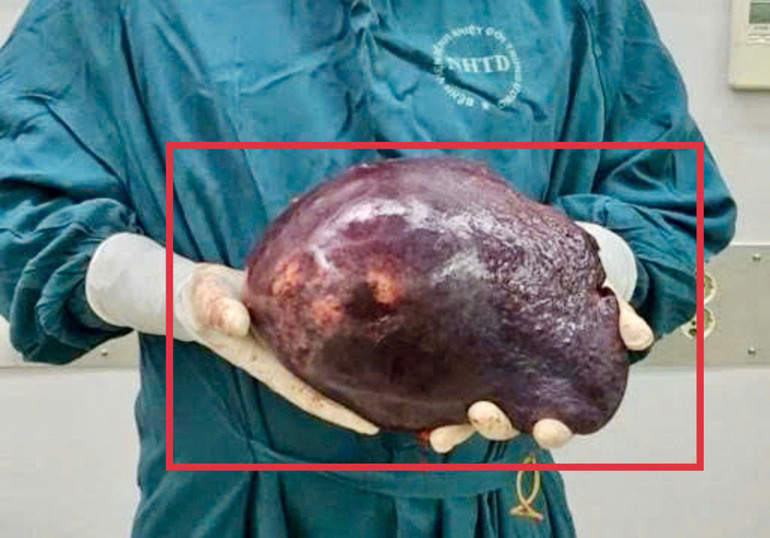 Khối u được cắt bỏ. z7173690835480-0955037eb2359be27b51f601e1aa6cda.jpg