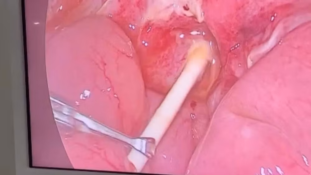Phẫu thuật nội soi lấy dị vật là que kẹo mút dài 6cm trong tá tràng bé 5 tuổi. (Ảnh do bệnh viện cung cấp)