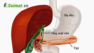 Chủ quan với sỏi túi mật, người phụ nữ bị tắc ruột