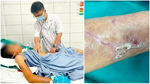 Bệnh nhân nằm điều trị tại Bệnh viện Bạch Mai do uốn ván. 