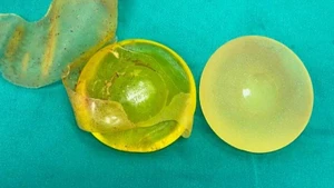 Túi ngực sau phẫu thuật tháo bỏ. 