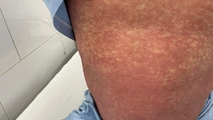 Hình ảnh người bệnh bị dị ứng với thuốc Phenylbutazone.