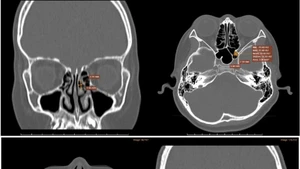 Hình ảnh chụp CT-Scanner xoang phát hiện tình trạng viêm đa xoang hàm mặt.