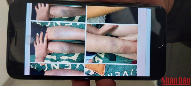 Những vết thương trên cơ thể em N.H.T.H.
