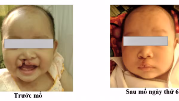 Một số hình ảnh người bệnh được phẫu thuật tại Bệnh viện Sản Nhi Nghệ An. (Ảnh: Bệnh viện cung cấp)