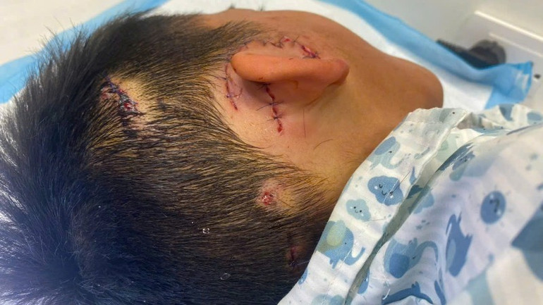 Tai cháu bé sau phẫu thuật Tai cháu bé sau phẫu thuật