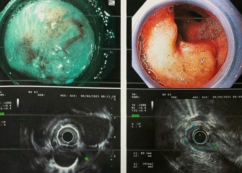 Hình ảnh nội soi, siêu âm nội soi dạ dày, thực quản của bệnh nhân T. cho thấy ung thư hai vị trí ở giai đoạn tương đối sớm. (Ảnh: BVCC) Hình ảnh nội soi, siêu âm nội soi dạ dày, thực quản của bệnh nhân T. cho thấy ung thư hai vị trí ở giai đoạn tương đối sớm. (Ảnh: BVCC)