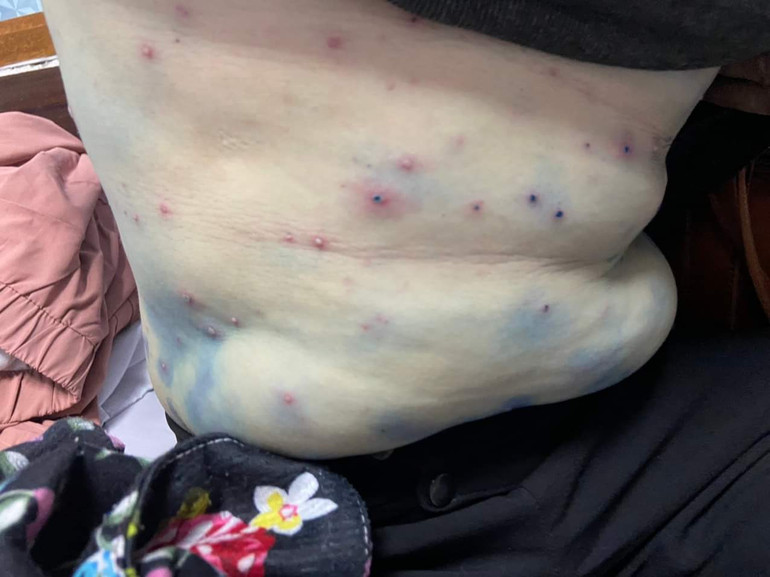 Các nốt phỏng nước xuất hiện trên khắp người bệnh.