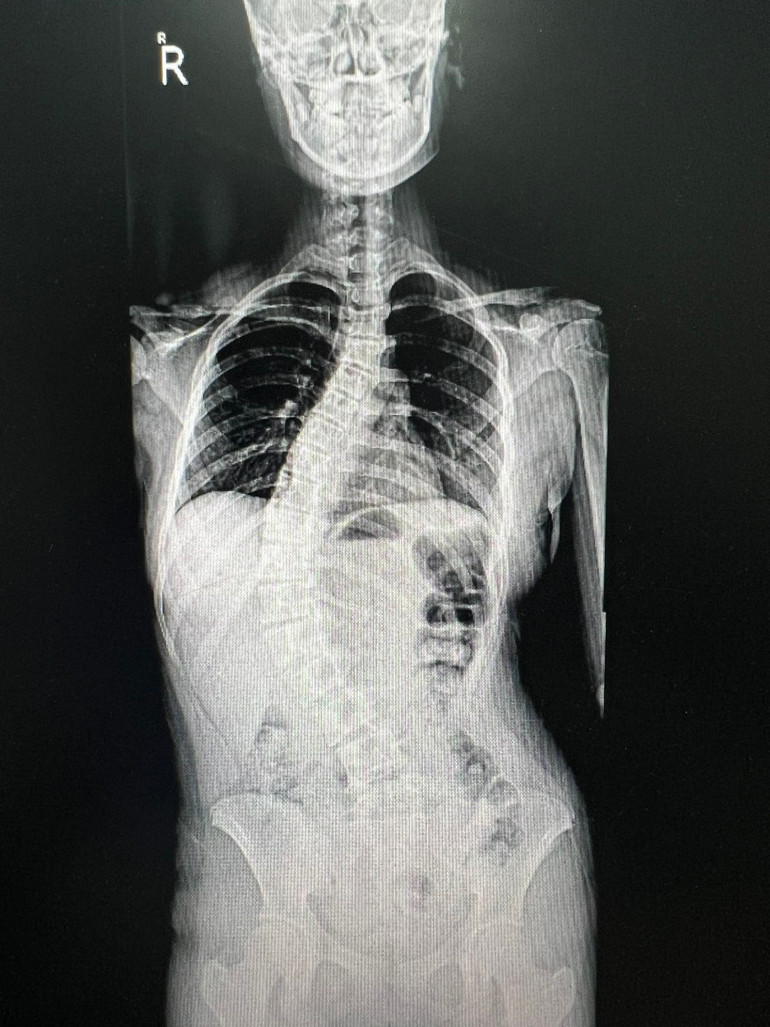 Hình ảnh gù vẹo cột sống ở trẻ em Hình ảnh gù vẹo cột sống ở trẻ em