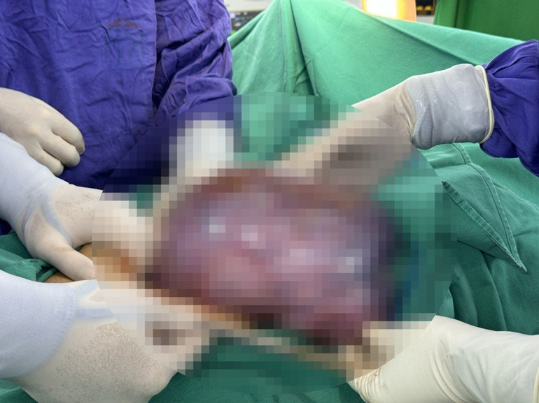 Khối u buồng trứng nặng gần 3kg được cắt bỏ thành công.