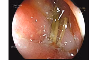 Hình ảnh nội soi ghi nhận dị vật dài khoảng 3cm, 1 đầu đâm sâu vào thành đại tràng, có dịch mủ chung quanh.