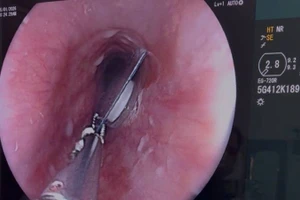 Viên thuốc còn nguyên bao kẽm kẹt trong thực quản người bệnh.