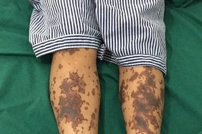 Một bệnh nhân mắc bệnh Liên câu lợn đang được điều trị tại bệnh viện. (Ảnh minh họa)