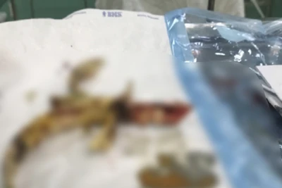 Dị vật kim loại (bông cửa sắt hàng rào) cắm chặt vào hộp sọ độ sâu 4-5 cm.