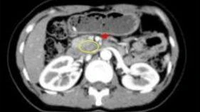 Sau hóa trị, tổn thương giảm kích thước so với phim chụp cũ, không còn thấy hình ảnh thâm nhiễm quanh động mạch mạc treo tràng trên.