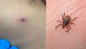 Vết loét điển hình do mò đốt.