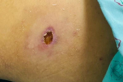 Dấu hiệu đặc trưng về bệnh sốt mò có vết loét hình bầu dục.