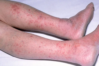 Nốt phát ban khi mắc viêm màng não do não mô cầu.