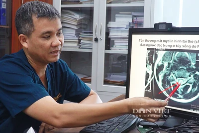 Tiến sĩ, bác sĩ Nguyễn Trung Nguyên cho biết tổn thương mắt myelin hình tai thỏ đảo ngược đặc trưng ở tủy sống do sử dụng N20. Ảnh: DÂN VIỆT