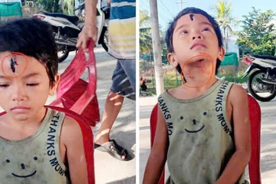 Thương tích trên người bé N.T.N được một người thầy giáo chia sẻ trên mạng xã hội. (Ảnh: SMART CHOICE KIÊN GIANG)