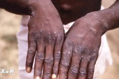 Bàn tay của bệnh nhân mắc đậu mùa khỉ tại CHDC Congo. (Ảnh: Getty Images/ TTXVN)