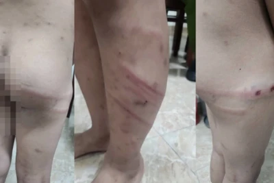 Hình ảnh cháu M. bị mẹ ruột và người tình của mẹ đánh đập gây thương tích nghiêm trọng.