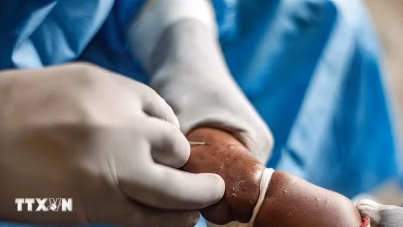 Nhân viên y tế điều trị cho bệnh nhân mắc đậu mùa khỉ tại Goma, Cộng hòa dân chủ Congo, ngày 15/8/2024. (Ảnh: THX/TTXVN)