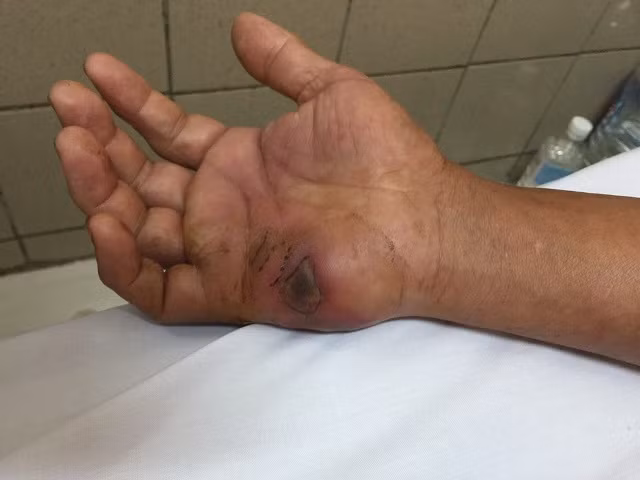 Hình ảnh nốt rắn hổ mang chúa cắn trên tay bệnh nhân.