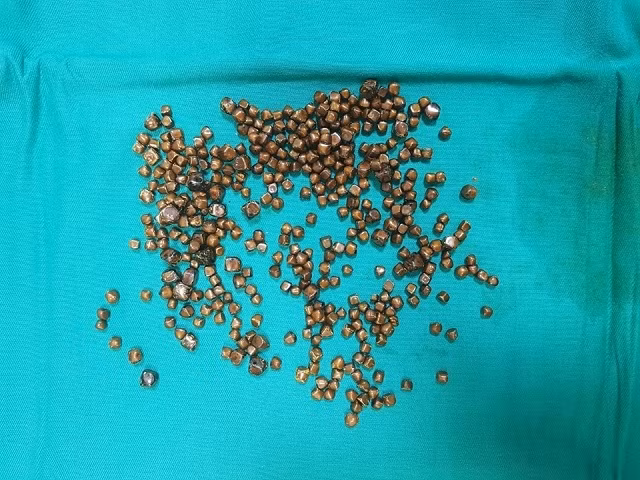 Gần 400 viên sỏi được lấy từ túi mật của bệnh nhân.