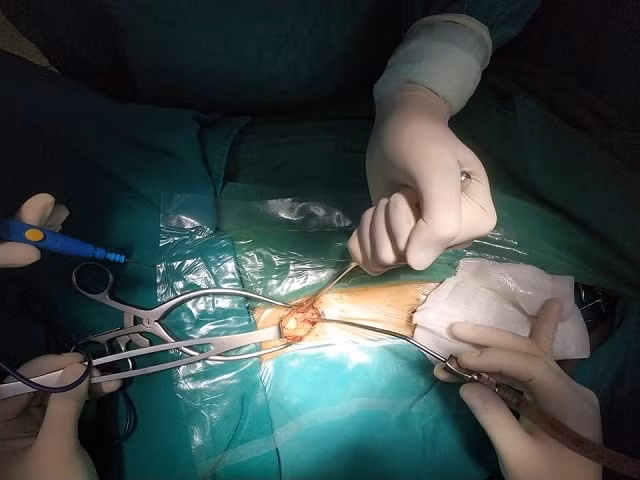Bệnh nhi được mổ giải phóng khối áp-xe ngoài màng cứng. 