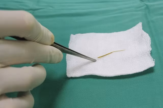 Mảnh xương cá dài 4 cm đâm thủng ruột non bệnh nhân. 