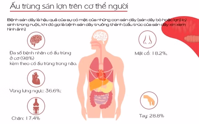 [Infographic] Nhận diện về bệnh sán dây, ấu trùng sán lợn