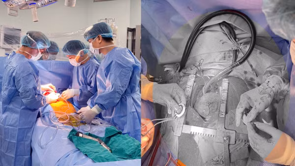 Bác sĩ cấy ghép CorHeart 6 cho bệnh nhân. (Ảnh: Bệnh viện cung cấp)