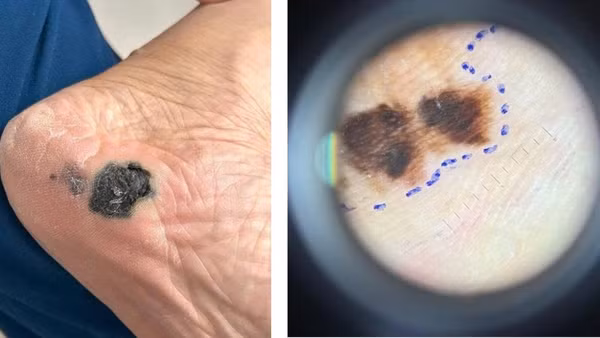 Hình ảnh ung thư tế bào hắc tố trên Dermoscope: màu sắc không đều, bất đối xứng. (Ảnh: Bác sĩ cung cấp)