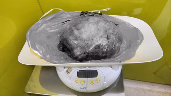 Khối u nặng 4kg. (Ảnh: BV cung cấp)