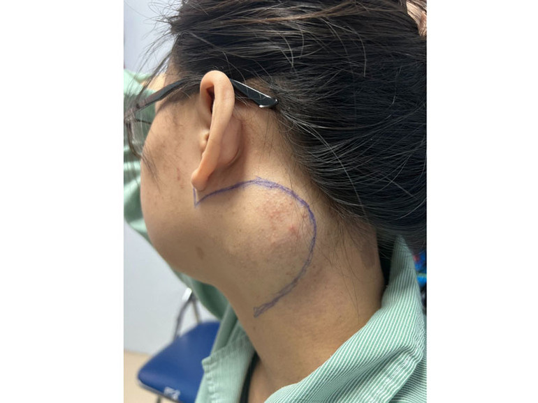 Vị trí khối u của người bệnh trước khi được các bác sĩ thực hiện ca phẫu thuật. Vị trí khối u của người bệnh trước khi được các bác sĩ thực hiện ca phẫu thuật.