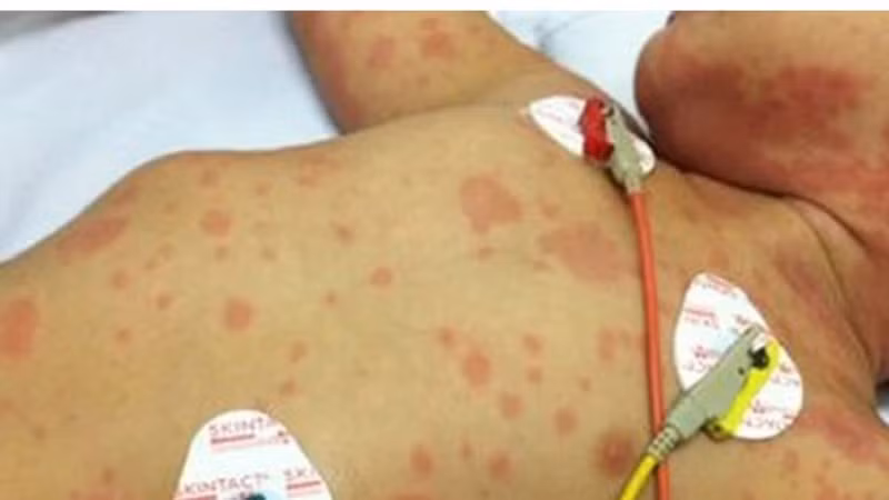 Trẻ em bị mắc bệnh viêm não mô cầu. (Ảnh minh họa)