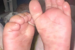 Vết ban rải rác ở gan bàn chân trẻ mắc giang mai bẩm sinh ở trẻ có triệu chứng, tổn thương. (Ảnh minh họa: Bệnh viện Da liễu Trung ương).