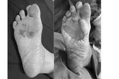 Bệnh nhân ung thư tế bào hắc tố gan chân trước và sau phẫu thuật. (Ảnh: BVCC)