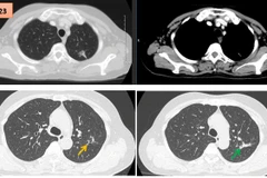 Hình ảnh cắt lớp vi tính theo dõi trong quá trình điều trị, tổn thương xơ hóa tại vị trí u cũ (mũi tên xanh) và giãn khu trú các nhánh phế quản liền kề (mũi tên vàng).