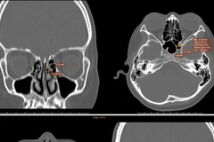 Hình ảnh chụp CT-Scanner xoang phát hiện tình trạng viêm đa xoang hàm mặt.