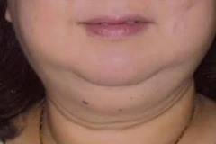 Bệnh nhân có mặt tròn, tăng cân bất thường do suy tuyến thượng thận. 