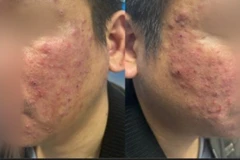 Viêm da mặt kéo dài, người bệnh bất ngờ phát hiện nhiễm ký sinh trùng Demodex