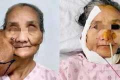 Bệnh nhân đã được phẫu thuật loại bỏ khối u khổng lồ.