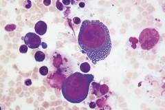 Parvovirus B19 tập trung lây nhiễm ở các tế bào phân chia nhanh, gây độc làm cho tế bào chết nhanh và gây viêm xung quanh. (Ảnh minh họa)