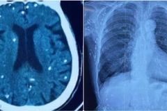 Hình ảnh chụp cắt lớp vi tính sọ não và X-quang ngực của bệnh nhân có nhiều tổn thương do nang sán - (Ảnh: BVCC).